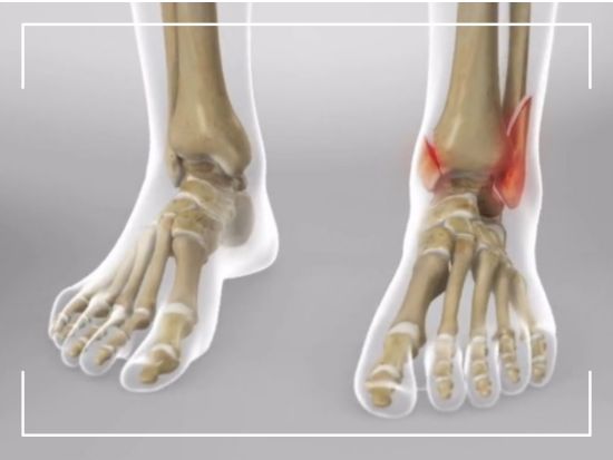 fracture surgery in panchkula dr pradeep aggarwal