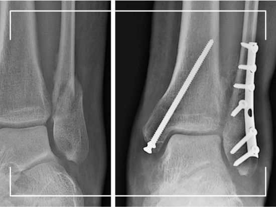 fracture surgery in panchkula dr pradeep aggarwal
